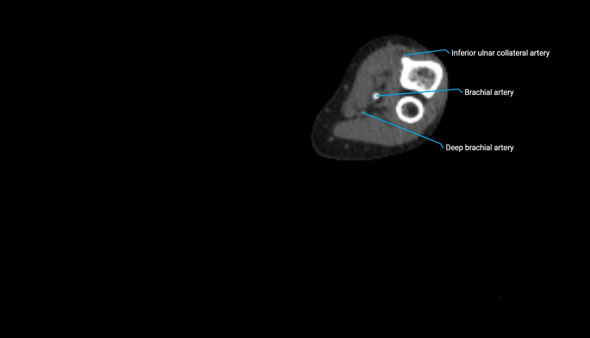 CTA upper limb axial cross sectional anatomy labelled image 179 (2).webp